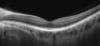 Retina Line 9 mm