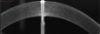 Anterior line 9 mm